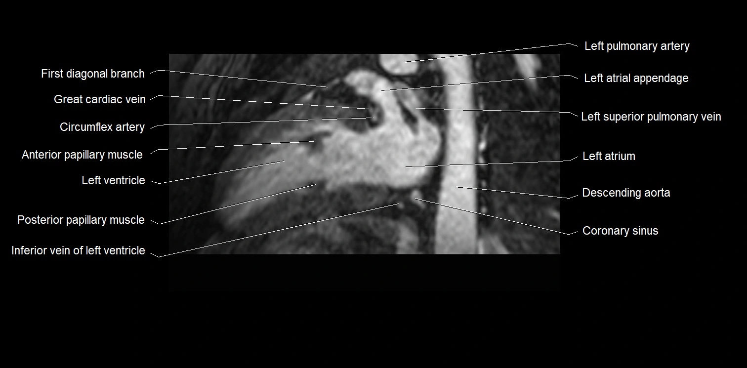 MRI heart and coronary arteries two chamber(sagittal)  anatomy image 30.webp